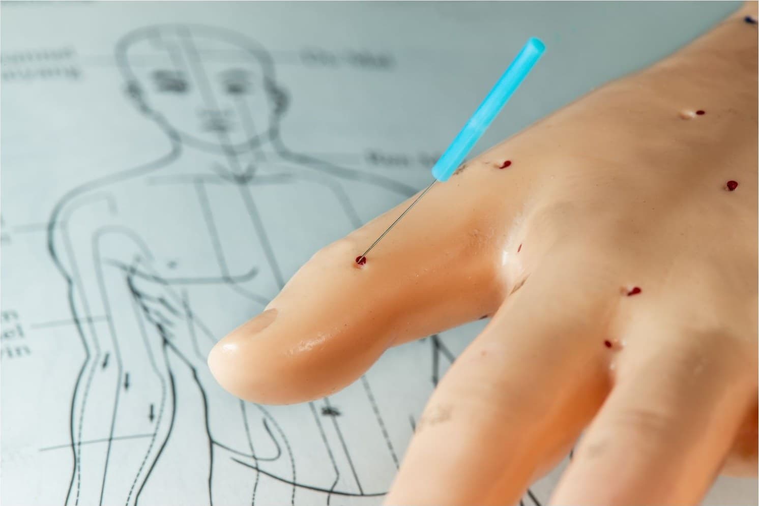 Acupuncture: Myths & Evidence