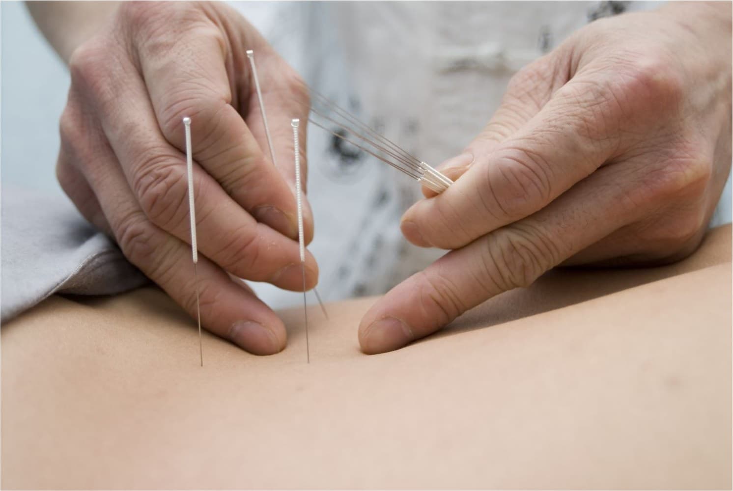 Acupuncture for Chronic Pain Relief